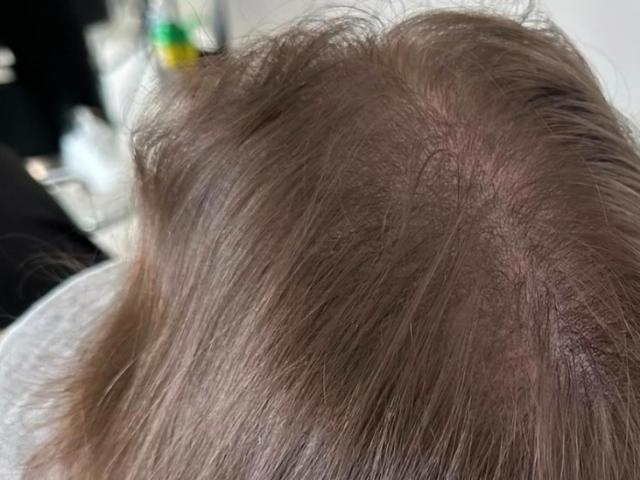 Redonnez vie a vos cheveux avec la tricopigmentation  chez beauty room 